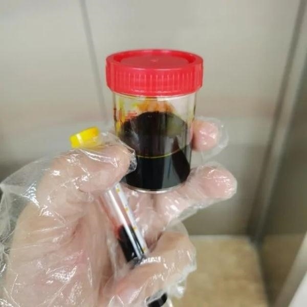 急性肝衰竭！兩兄弟誤吃這種菌 專(zhuān)家提醒