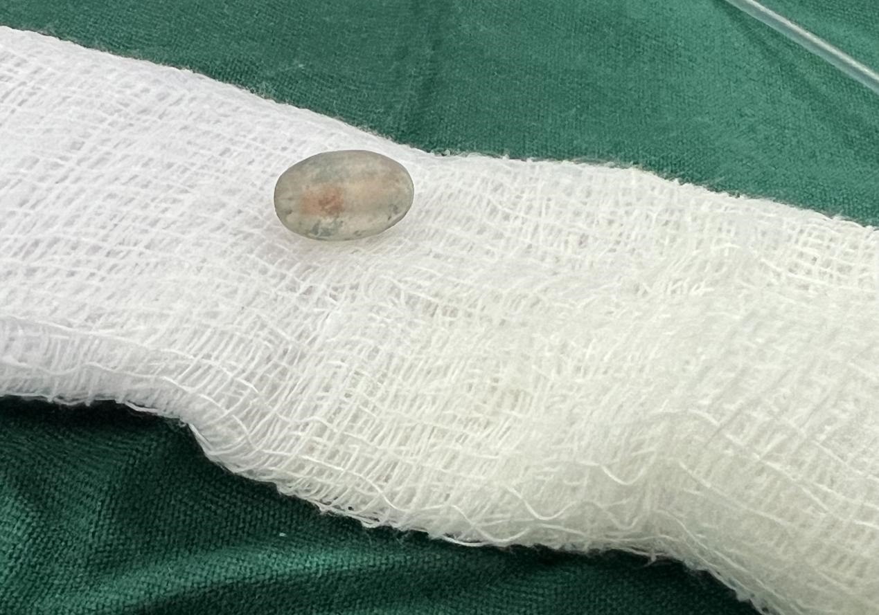 被取出的異物。中國援桑醫(yī)療隊供圖